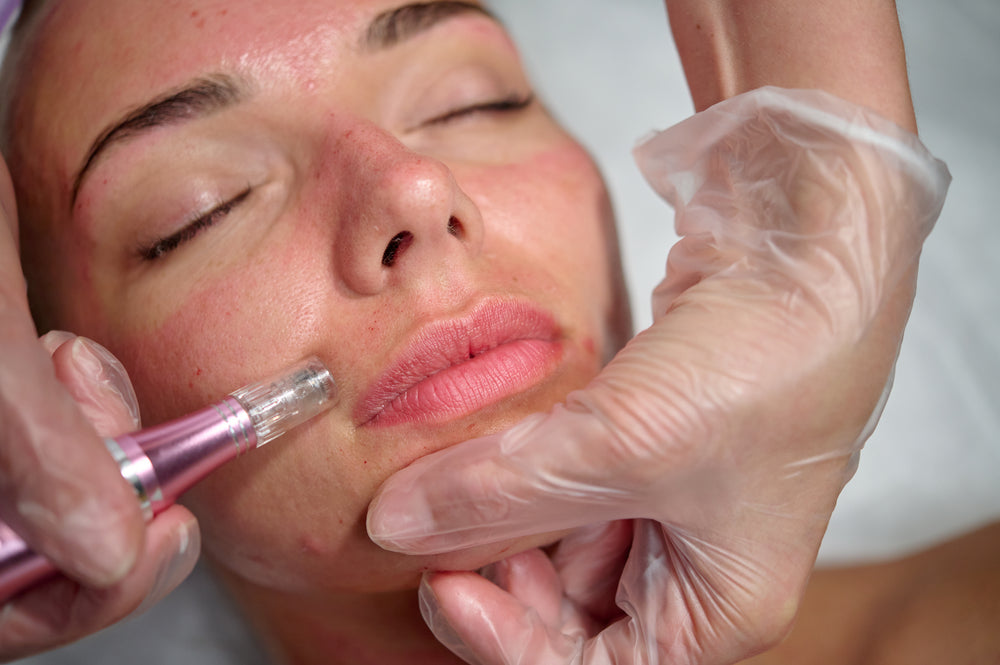 Microneedling CIT Treatment